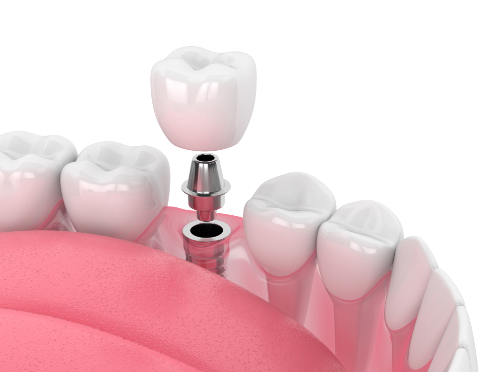 Dental Implants LaFollette